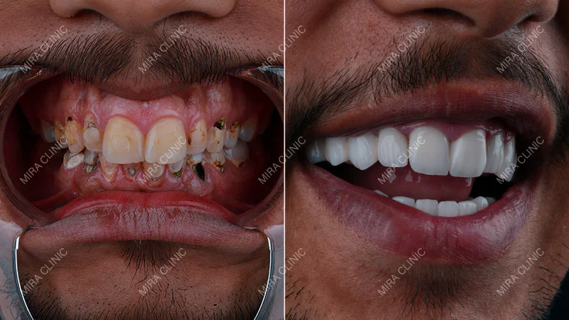 Before and After Rayan’s Dental Treatment